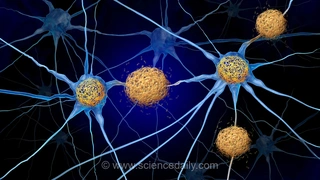 تغییرات آلزایمر ممکن است سال‌ها قبل از ظهور پلاک‌ها در مغز ایجاد شود