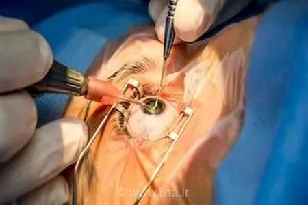 جراحی موفقیت‌آمیز اختلالات نادر حرکتی چشم برای نخستین بار در استان مرکزی
