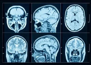 یک روش جدید برای پیش‌بینی سرعت وخامت بیماری پارکینسون