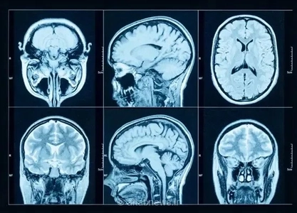 یک روش جدید برای پیش‌بینی سرعت وخامت بیماری پارکینسون