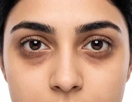 علت تیرگی و پف زیر چشم و روش‌های مراقبت
