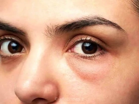 راز چشم‌های شاداب و بدون پف در انجام این کارهاست