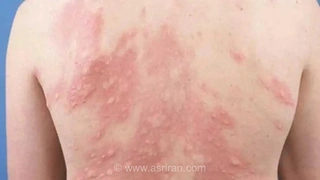 علائم کهیر: راهنمای تشخیص و درک این عارضه پوستی