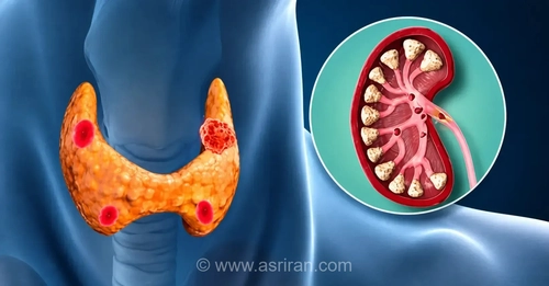 دلایل ایجاد سنگ کلیه و راه‌های پیشگیری از آن
