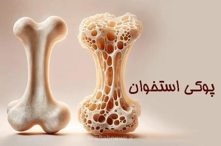 ساخت استخوان‌های قوی از جوانی با تغذیه و فعالیت بدنی