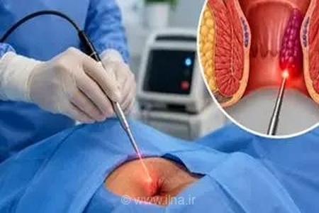 چرا درمان بواسیر با لیزر به انتخاب اول بیماران تبدیل شده است؟