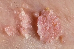 زگیل‌ها چگونه ایجاد می‌شوند و از چه طریقی منتقل می‌شوند؟ توضیحات متخصص پوست