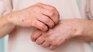 پاییز؛ فصل بروز علائم سالک / تب شالیزار چیست؟