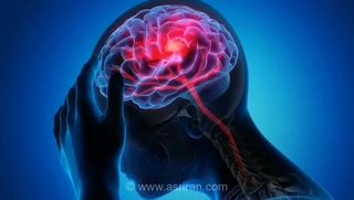 سکته مغزی در ایران؛ افزایش آمار و کاهش سن ابتلا