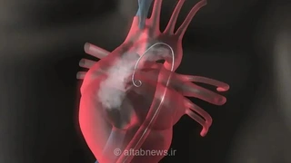 انجام نخستین جراحی رباتیک نقص مادرزادی قلب با هوش مصنوعی در چین