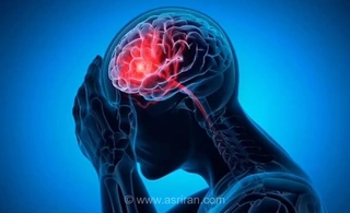 ارتباط میگرن با یک عارضه خطرناک در میانسالی