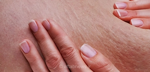 خداحافظی با سلولیت؛ راهکارهای طلایی و ساده برای درمان خانگی و بهبود ظاهر پوست در کمترین زمان