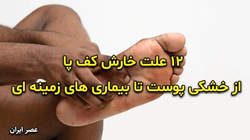 ۱۲ علت خارش کف پا؛ از خشکی پوست تا بیماری‌های زمینه‌ای