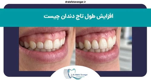 افزایش طول تاج دندان (لیفت لثه) چیست و چگونه انجام می‌شود؟