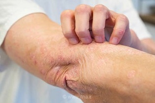 پسوریازیس: بیماری فراتر از مشکلات پوستی که سلامت قلب و روان را هم تهدید می‌کند