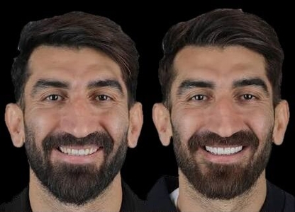 هزینه لبخند زیبا برای ورزشکاران؛ از کامپوزیت تا ایمپلنت