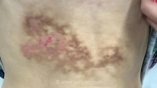 لپ‌تاپ، عامل اشتباه تشخیص آسیب کبدی در یک نوجوان
