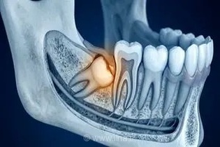 دندان عقل نهفته چیست و در چه شرایطی جراحی آن برای سلامت دهان و دندان ضروری می‌شود؟