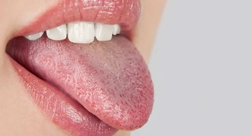 تغییر رنگ زبان می‌تواند نشانه‌ای از مشکلات سلامتی باشد