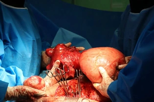 خارج کردن توده ۴ کیلویی از شکم بانوی ۴۶ ساله در بابل