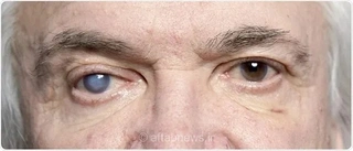 مقابله با نابینایی ناشی از دیابت با سلول‌های بنیادی پرورش یافته در آزمایشگاه