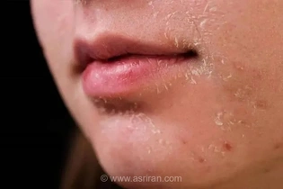 دلایل خشکی پوست صورت و راهکارهای درمان آن