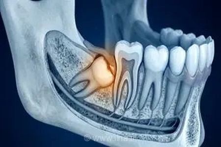 دندان عقل نهفته چیست و در چه شرایطی جراحی آن برای سلامت دهان و دندان ضروری می‌شود؟
