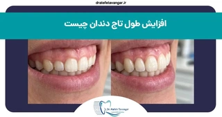 افزایش طول تاج دندان (لیفت لثه) چیست و چگونه انجام می‌شود؟