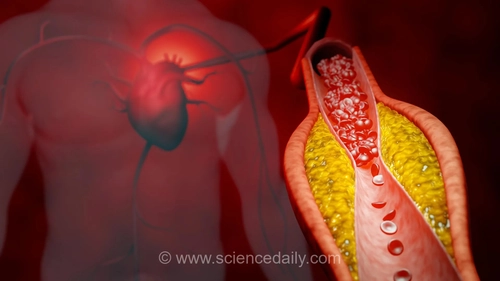 درمان مبتنی بر DNA کلسترول بد را تا ۵۰ درصد کاهش می‌دهد، بدون نیاز به استاتین