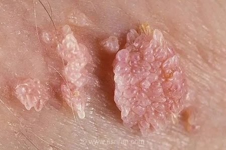 زگیل‌ها چگونه ایجاد می‌شوند و از چه طریقی منتقل می‌شوند؟ توضیحات متخصص پوست