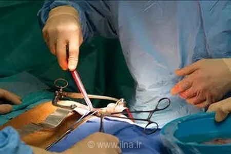 سیزدهمین اهدای عضو سال جاری در اهواز، جان چند بیمار نیازمند پیوند را نجات داد