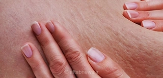 خداحافظی با سلولیت؛ راهکارهای طلایی و ساده برای درمان خانگی و بهبود ظاهر پوست در کمترین زمان