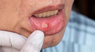 5 روش کاهش درد و بهبود آفت دهان
