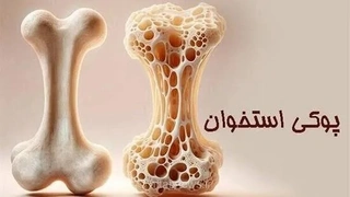 هشدار پزشکان؛ پوکی استخوان تا زمان شکستگی بی‌علامت است