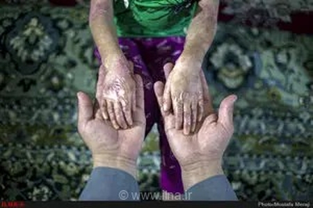 تلاش خانه ای‌بی برای کاهش رنج بیماران پروانه‌ای در مناطق گرمسیر کشور با توزیع پنکه‌های شارژی