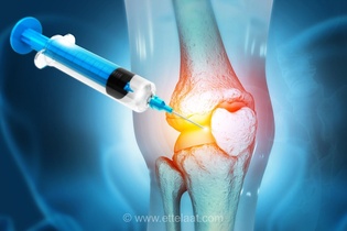 تزریق ژل جدید، راهکاری امیدوارکننده برای درمان طولانی‌مدت آرتروز