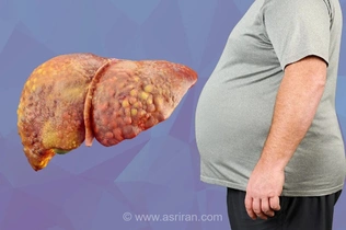 چرا شکم شما با ورزش آب نمی‌شود؟ راز پنهان کبد چرب در مقاومت بدن برای کاهش وزن