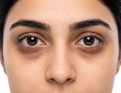 علت تیرگی و پف زیر چشم و روش‌های مراقبت