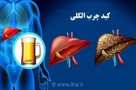 خطر خاموش آسیب‌های کبدی ناشی از مصرف الکل؛ حتی مقادیر کم هم خطرناک است