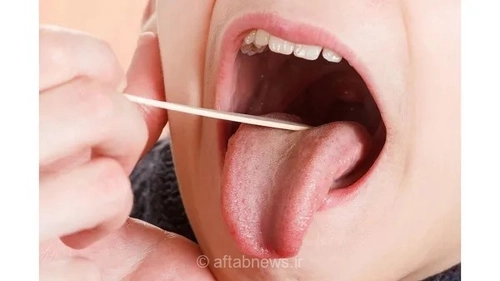 زخم دهان؛ علت، درمان و راه‌های پیشگیری از این عارضه آزاردهنده